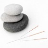 Acupuncture Shreveport