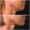 Newport Fat Loss