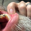 Wisdom Teeth & General Dentistry