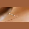 Joey Raquel Acupuncture
