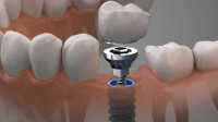 Dental Implants