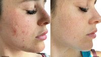 Microneedling