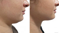 Kybella