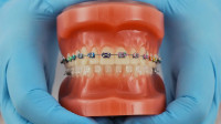 Braces