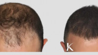 FUT Hair Transplant