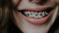 Adult Orthodontics