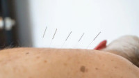 Acupuncture Services