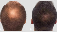 Hair Restoration