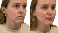 Dermal Fillers